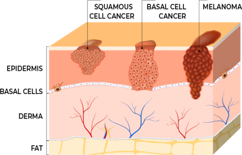 Squamous Cell Carcinoma diagram