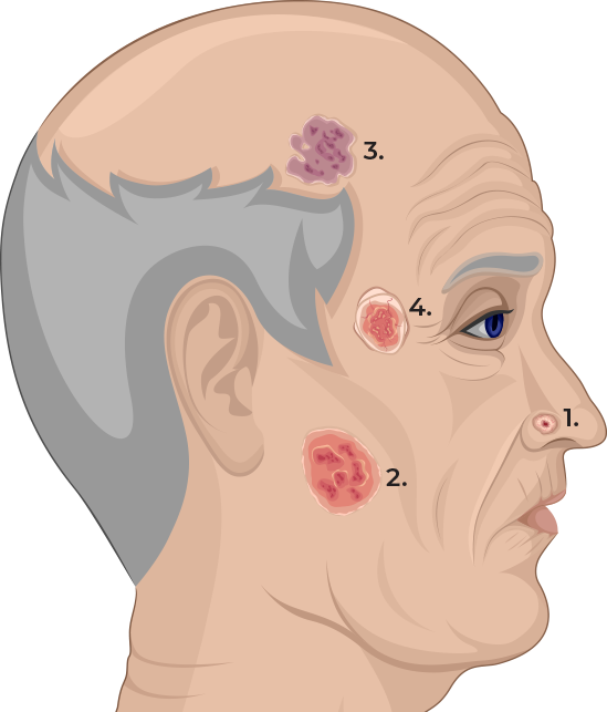 Mans head showing types of BCC Cancer