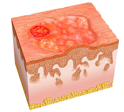 Squamous Cell Carcinoma diagram