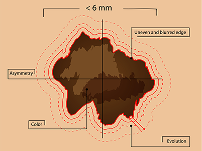 Diagram explaining Melanoma