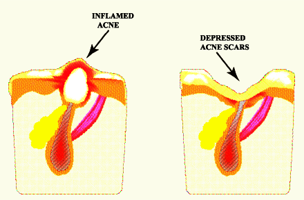 Inflamed Acne, and Depressed Acne Scars diagram