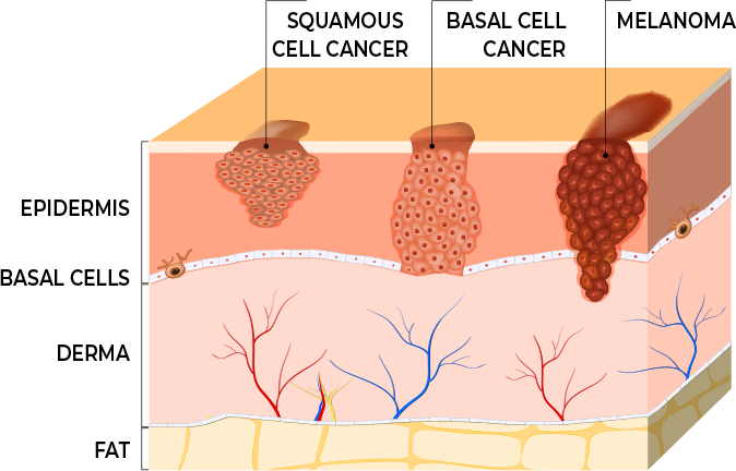 Cross section of skin showing types of cancer