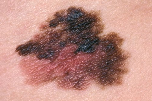 Melanoma Cancer