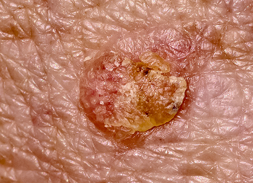 Actinic Keratosis