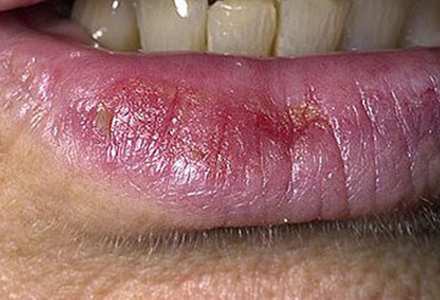 Actinic Cheilitis