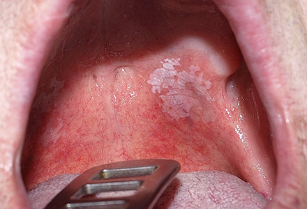 Leukoplakia