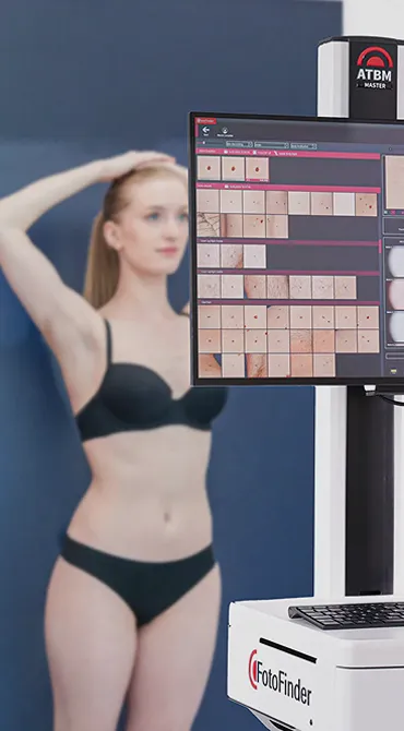 AI-Assisted Total Body  Mole Mapping