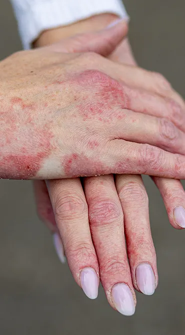 Medical  Dermatology