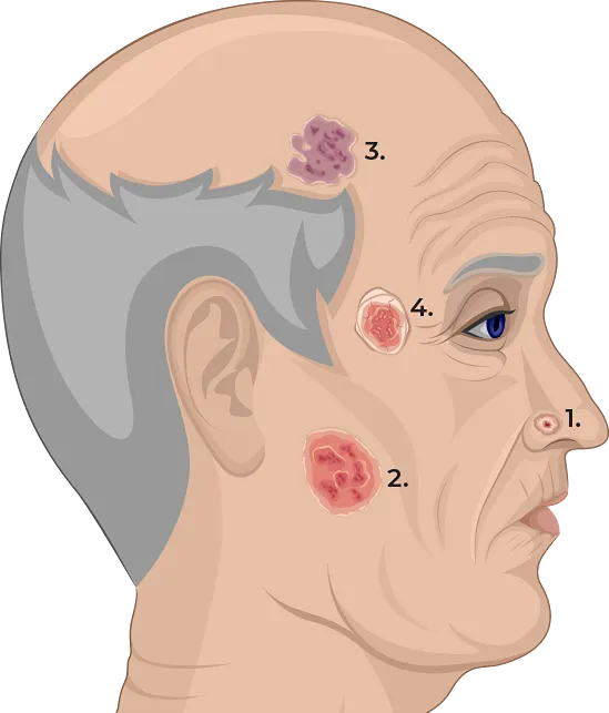 Basal Cell Carcinoma